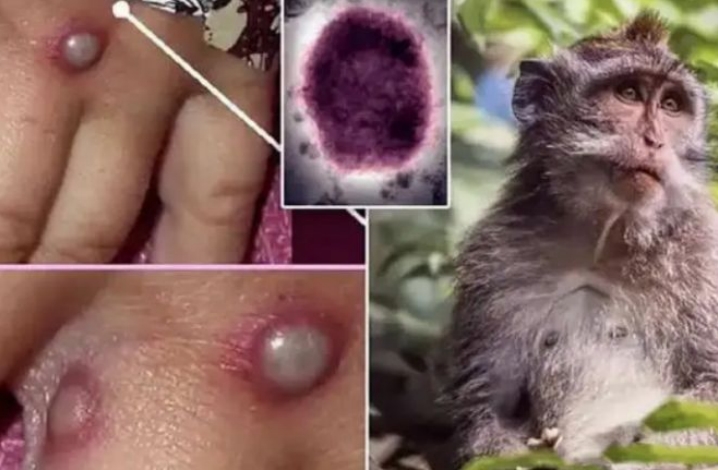 猴痘健康防护