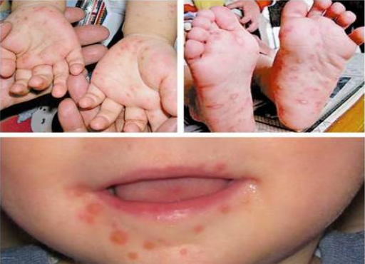 手足口病常见误区